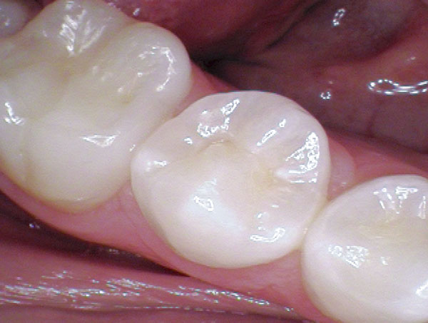 Scellant dentaire