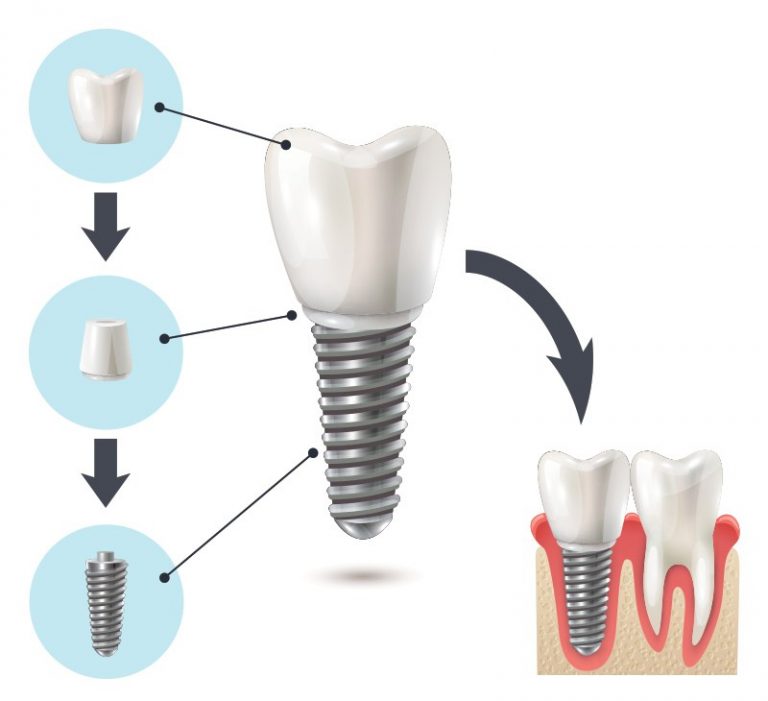 Centre Médical Et Dentaire Pantin - Implant Dentaire - Invisalign